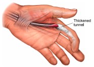 Trigger Finger Fife Virtual Hand Clinic