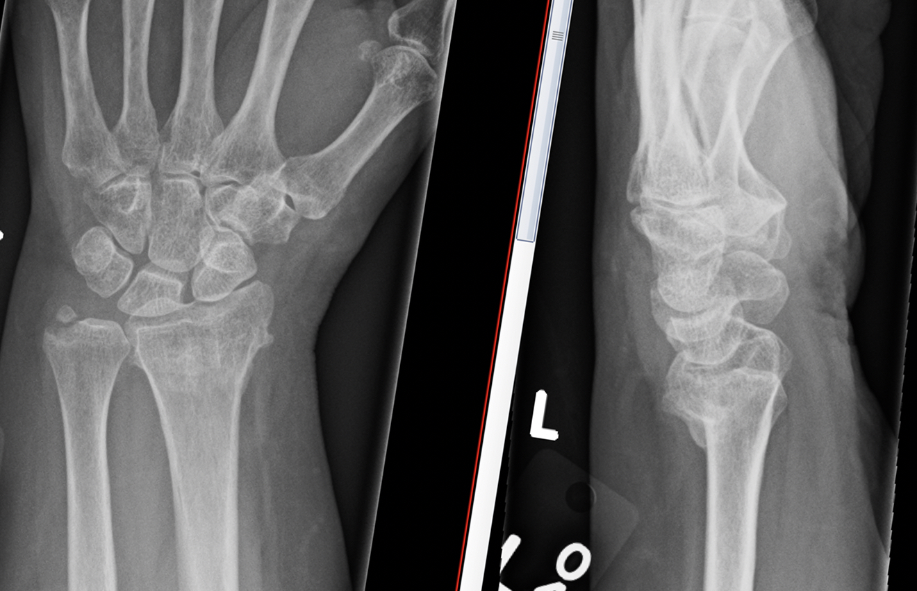 Malunion of the Distal Radius – Fife Virtual Hand Clinic