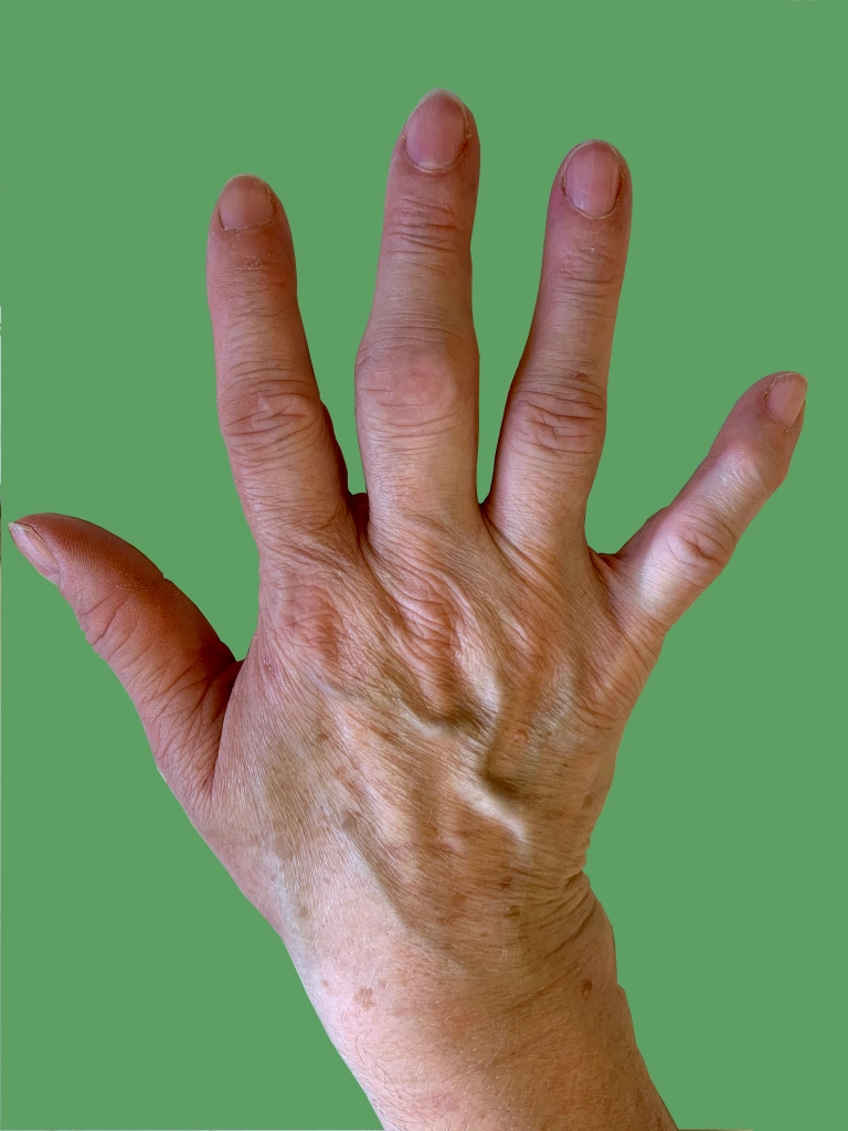 Wanneer betekent hand- of polspijn artritis?